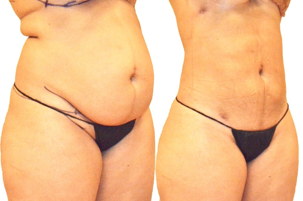 My Liposuction Journey: Real Stories, Real Results, Real Inspiration 143 1 2