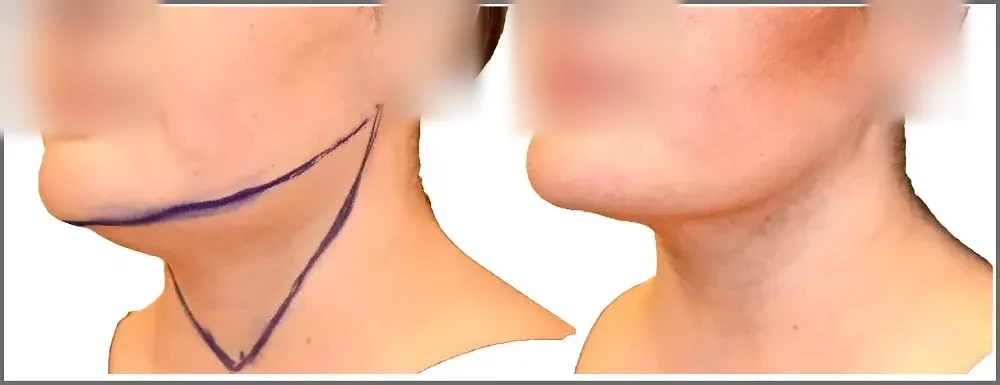 Before/After Chin and neck liposuction before and after, actual patient of Dr. Long