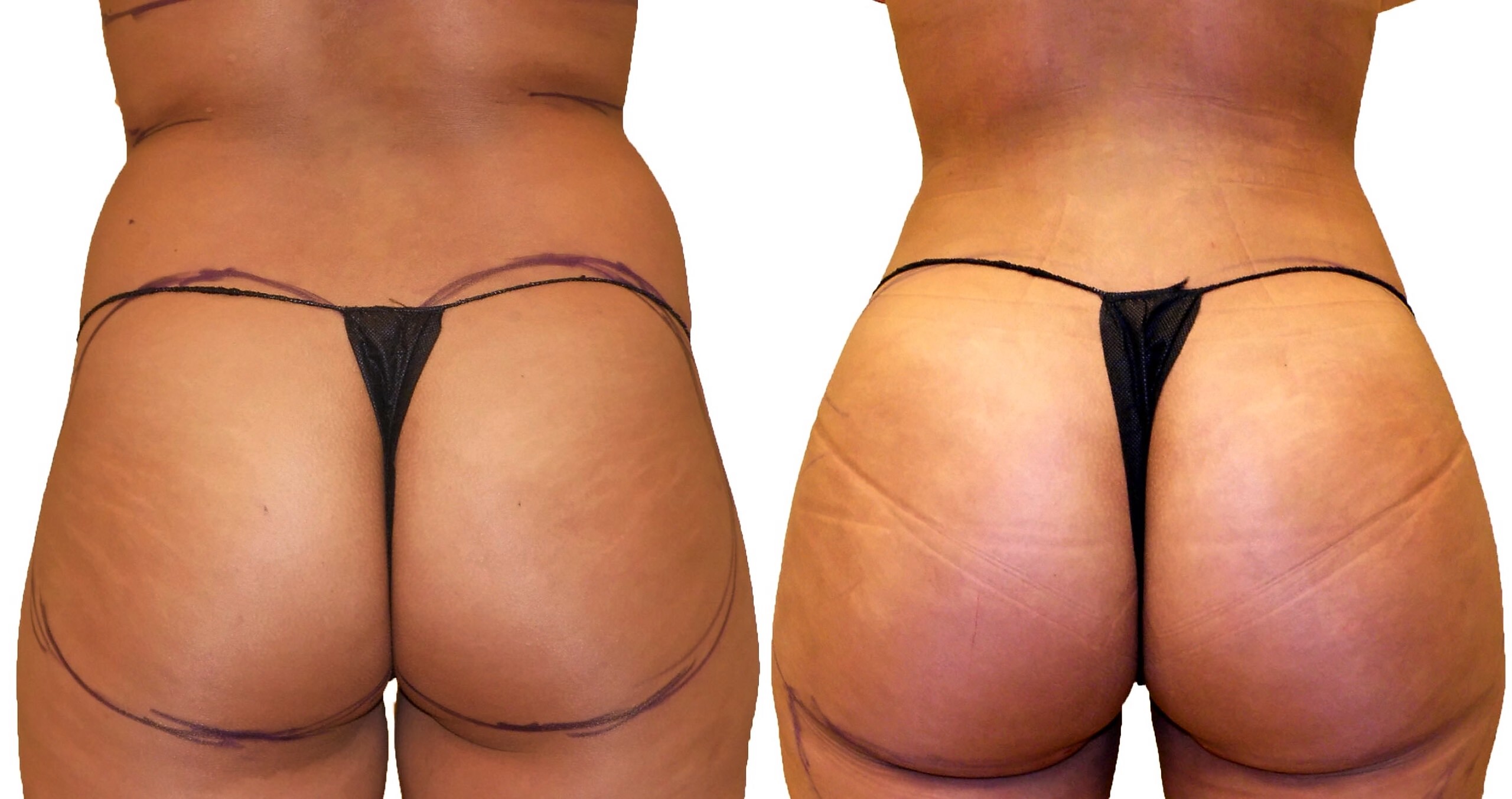 Before/After Fat Transfer, BBL before and after, actual patient of Dr. Long