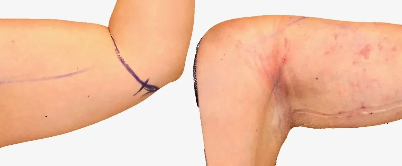 Before/After Arm liposuction before and after, actual patient of Dr. Long