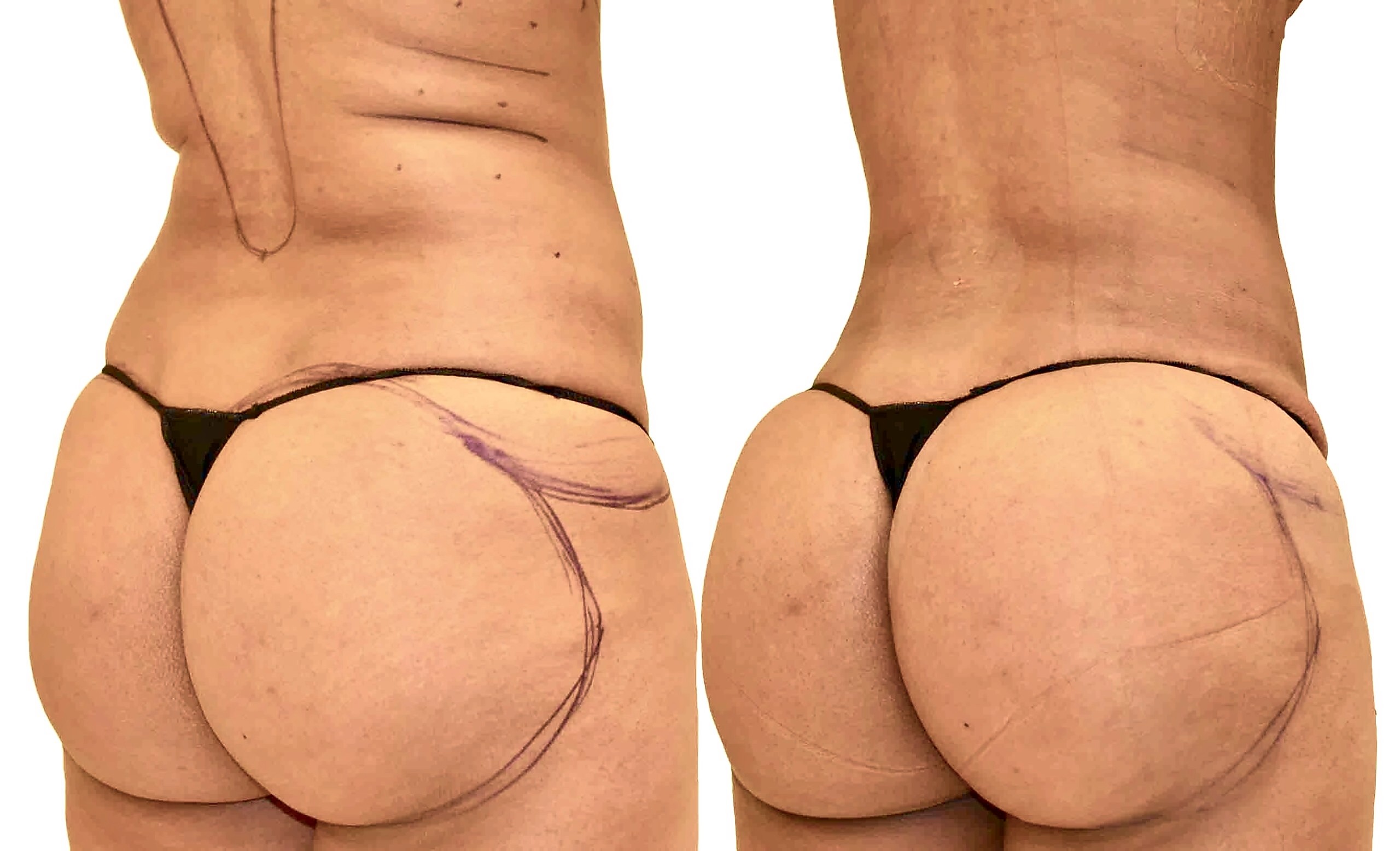 Before/After Fat Transfer, BBL before and after, actual patient of Dr. Long