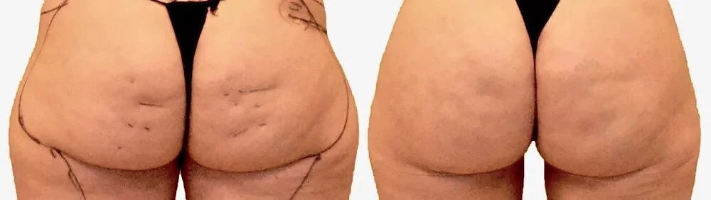 Before/After Thigh liposuction before and after, actual patient of Dr. Long