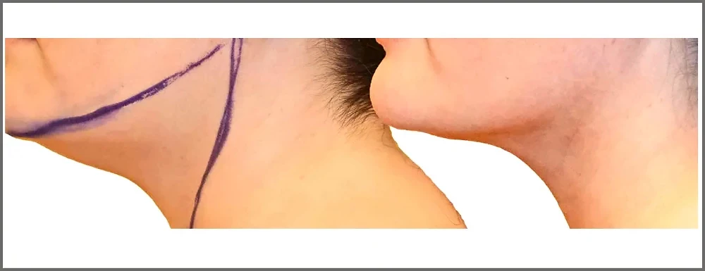 Before/After Chin and neck liposuction before and after, actual patient of Dr. Long