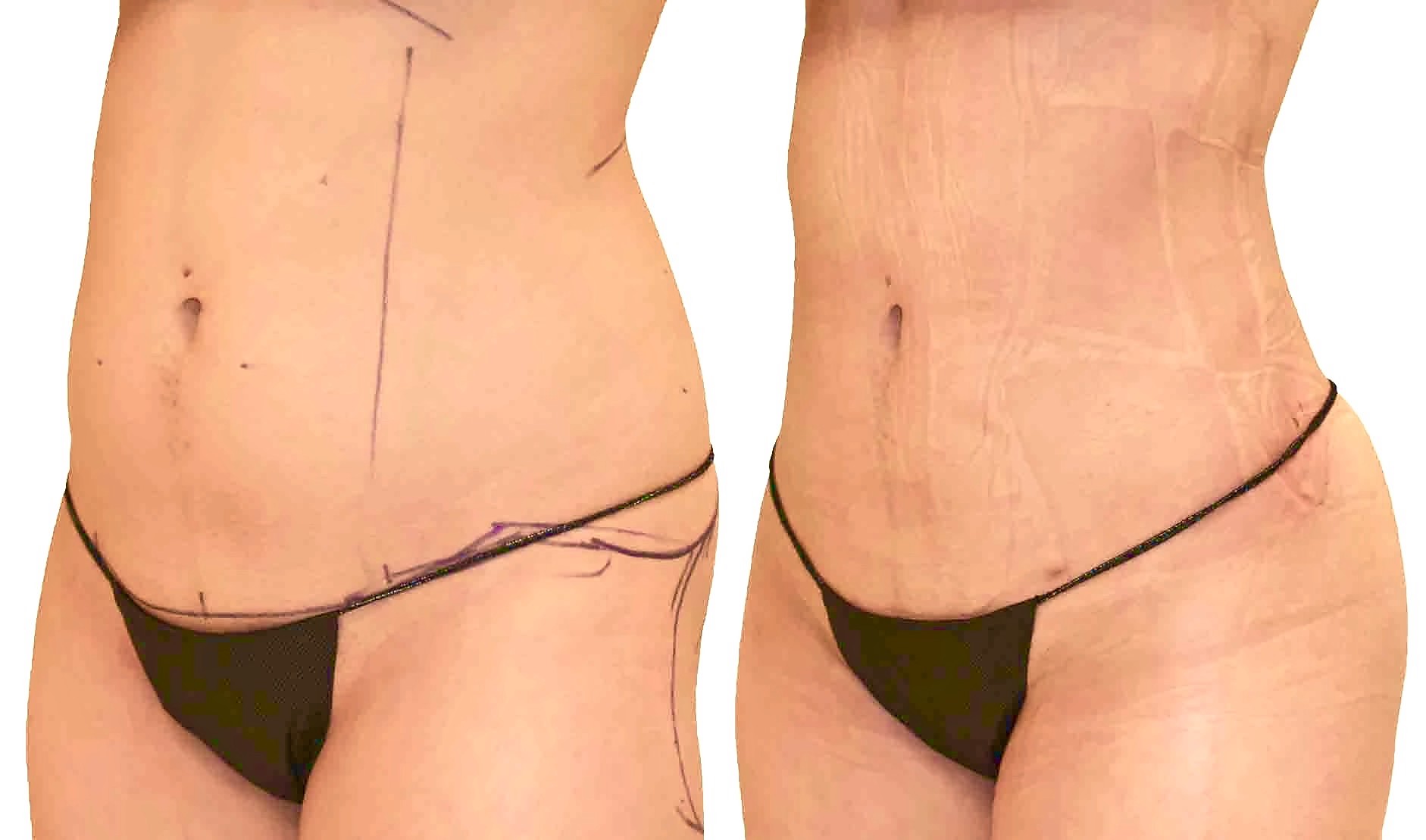 Before/After Lipo 360 before and after, actual patient of Dr. Long