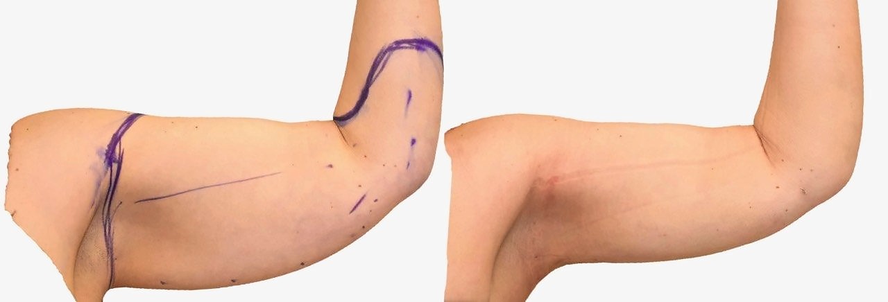 Home Arm Lipo before and after, actual patient of Dr. Long