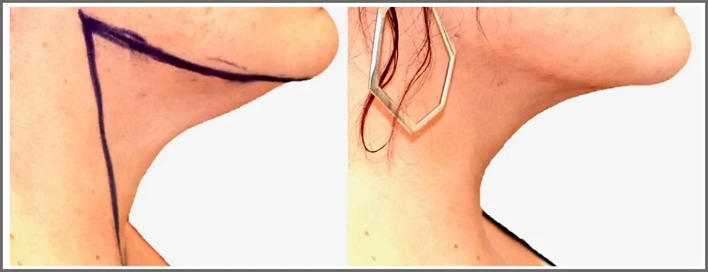 Home Chin & Neck Lipo before and after, actual patient of Dr. Long