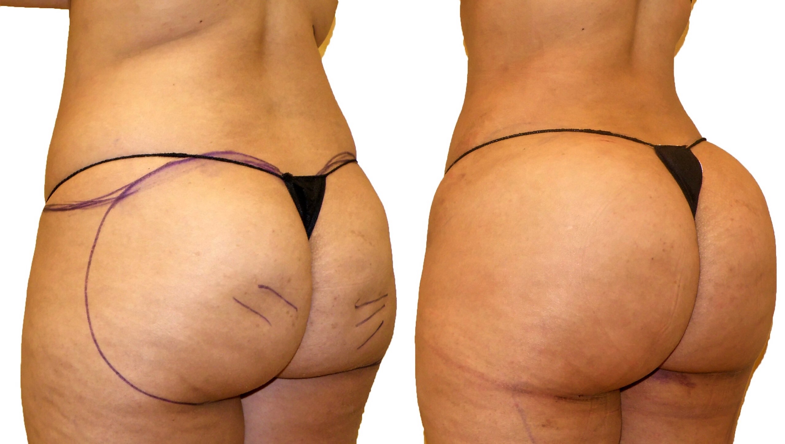 Before/After Fat Transfer, BBL before and after, actual patient of Dr. Long