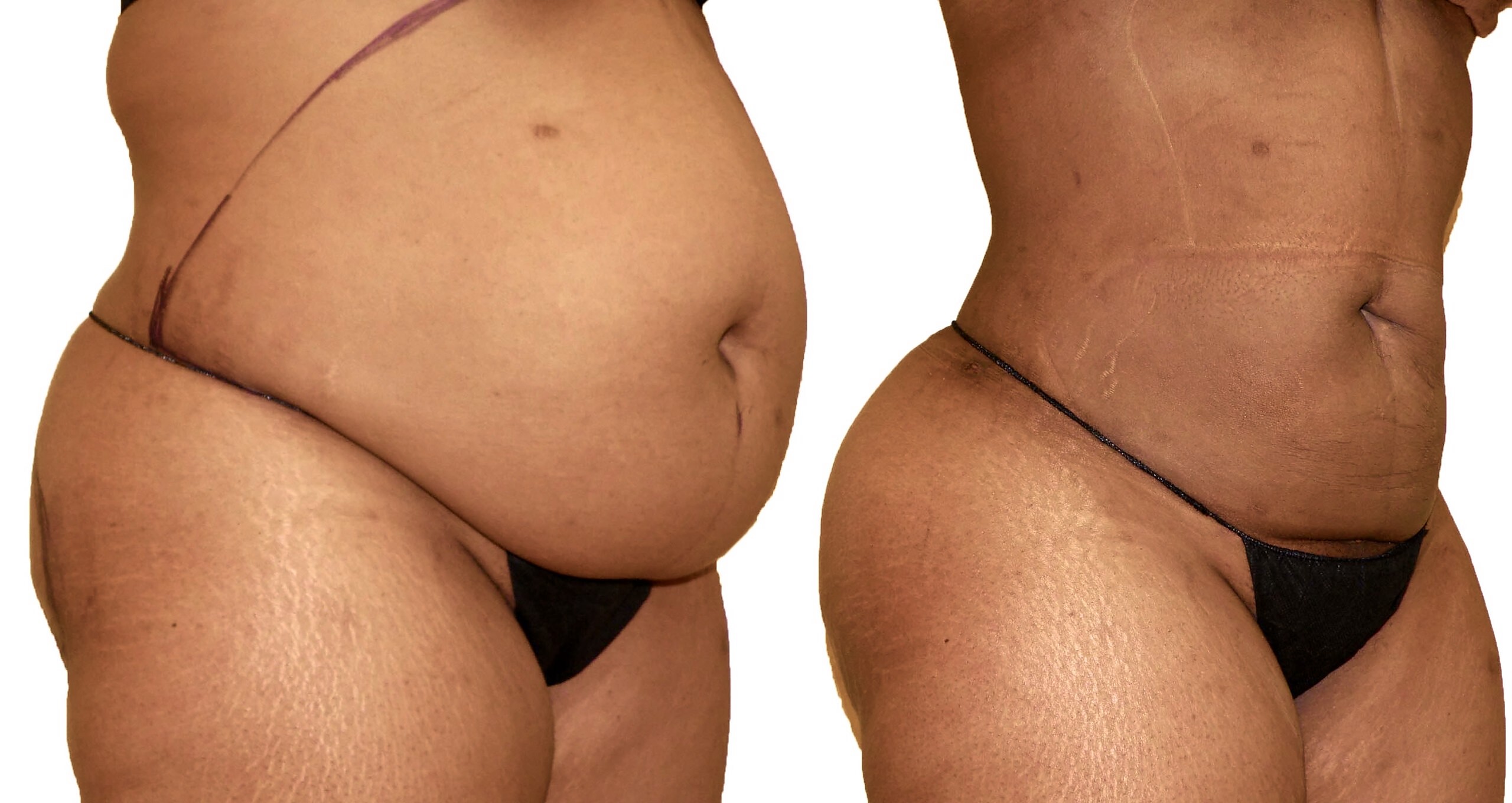 Before/After Lipo 360 before and after, actual patient of Dr. Long