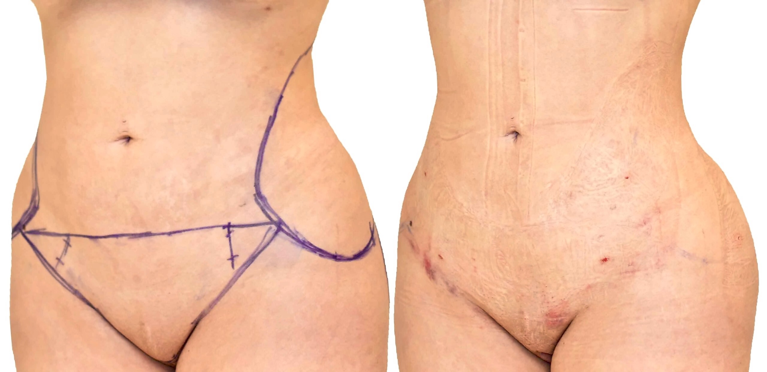 Before/After Lipo 360 before and after, actual patient of Dr. Long