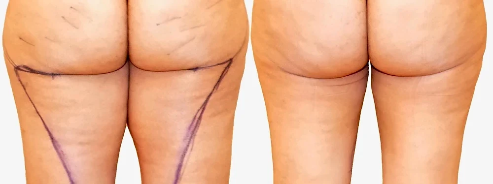 Before/After Thigh liposuction before and after, actual patient of Dr. Long