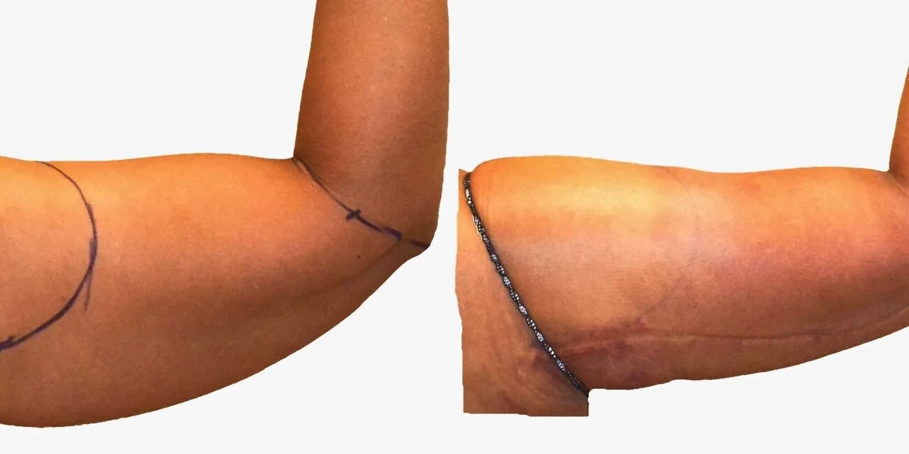 Before/After Arm liposuction before and after, actual patient of Dr. Long
