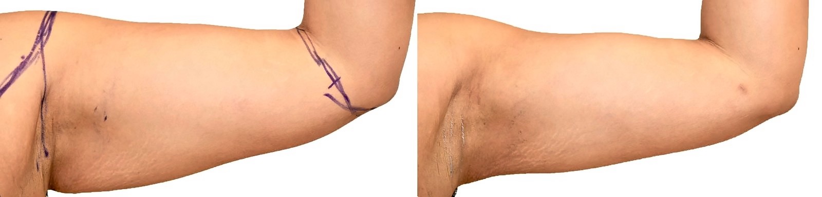 Before/After Arm liposuction before and after, actual patient of Dr. Long