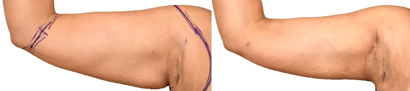 Before/After Arm liposuction before and after, actual patient of Dr. Long