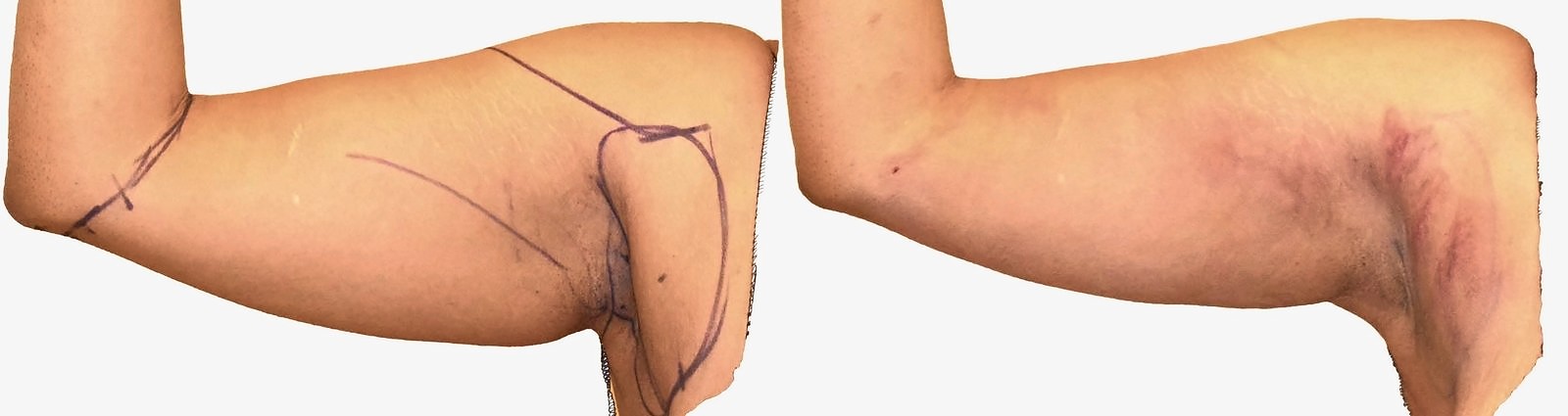 Before/After Arm liposuction before and after, actual patient of Dr. Long