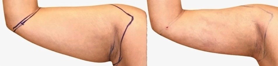 Before/After Arm liposuction before and after, actual patient of Dr. Long