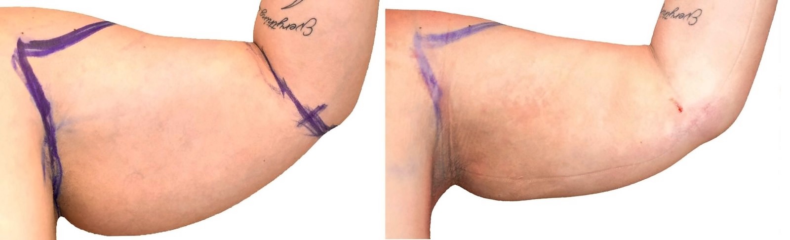 Before/After Arm liposuction before and after, actual patient of Dr. Long