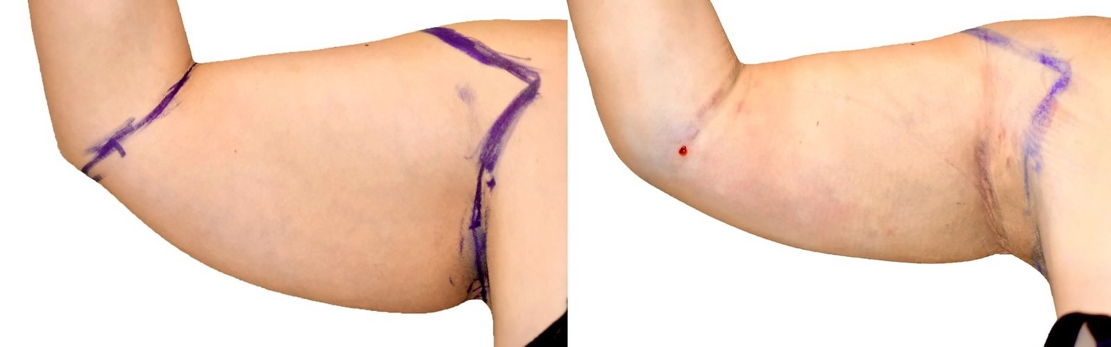 Before/After Arm liposuction before and after, actual patient of Dr. Long