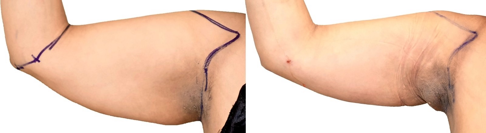 Before/After Arm liposuction before and after, actual patient of Dr. Long