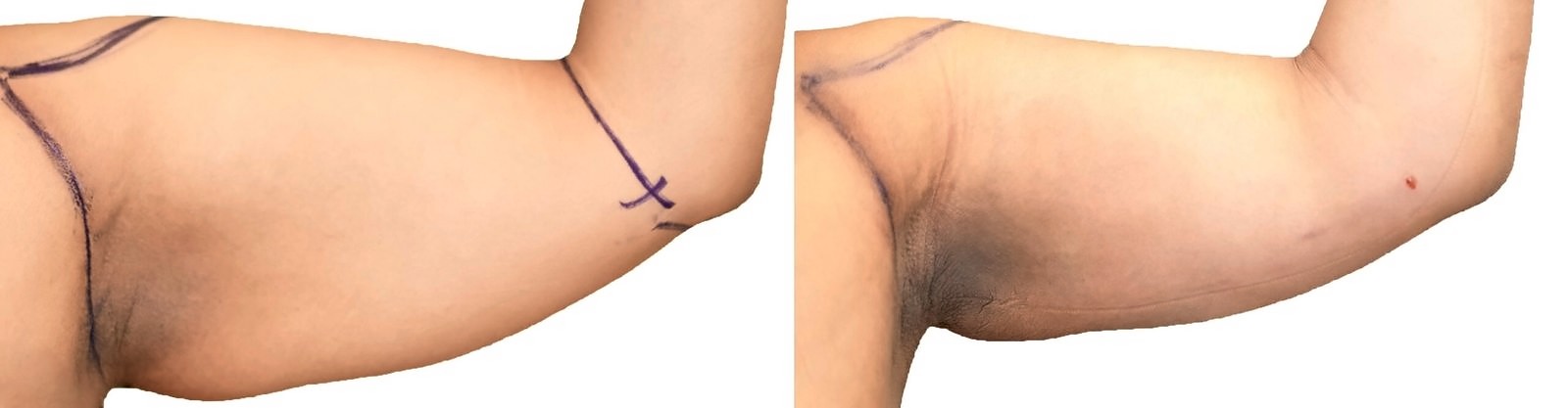Before/After Arm liposuction before and after, actual patient of Dr. Long