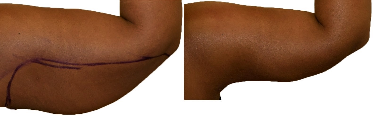 Before/After Arm liposuction before and after, actual patient of Dr. Long