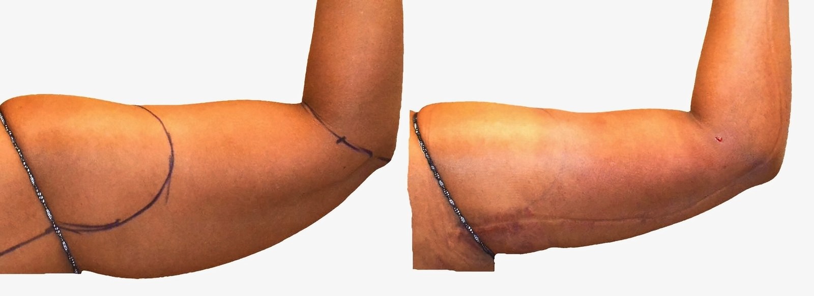 Before/After Arm liposuction before and after, actual patient of Dr. Long