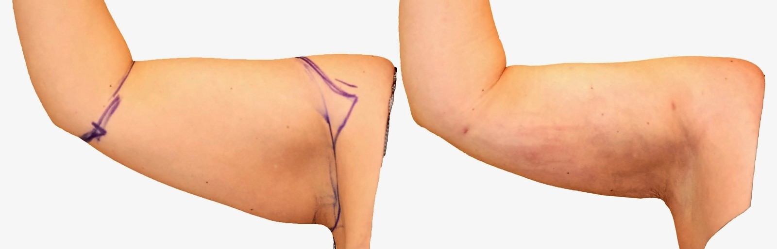 Before/After Arm liposuction before and after, actual patient of Dr. Long