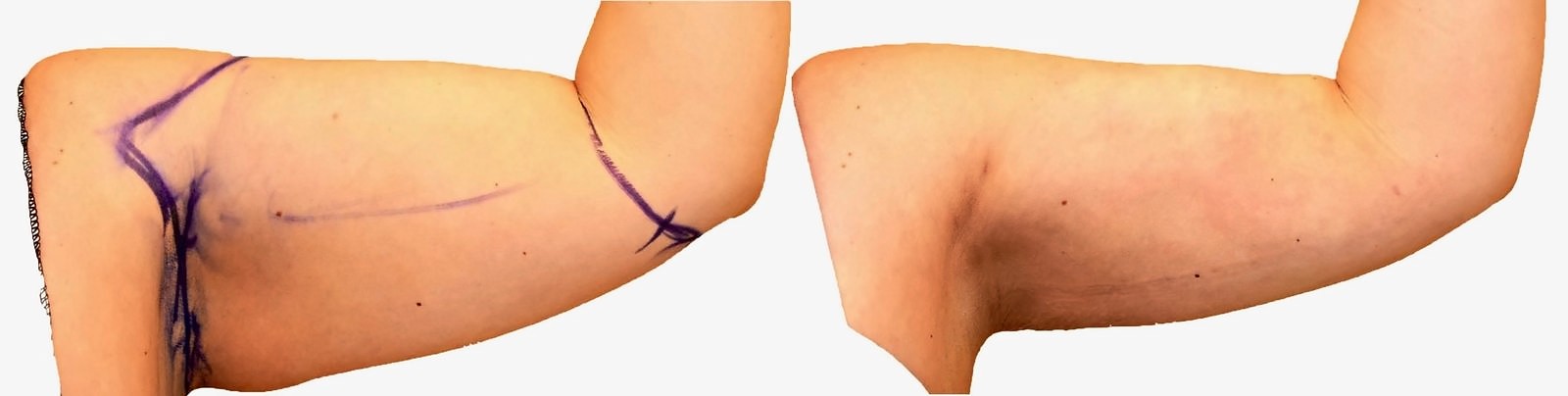 Before/After Arm liposuction before and after, actual patient of Dr. Long