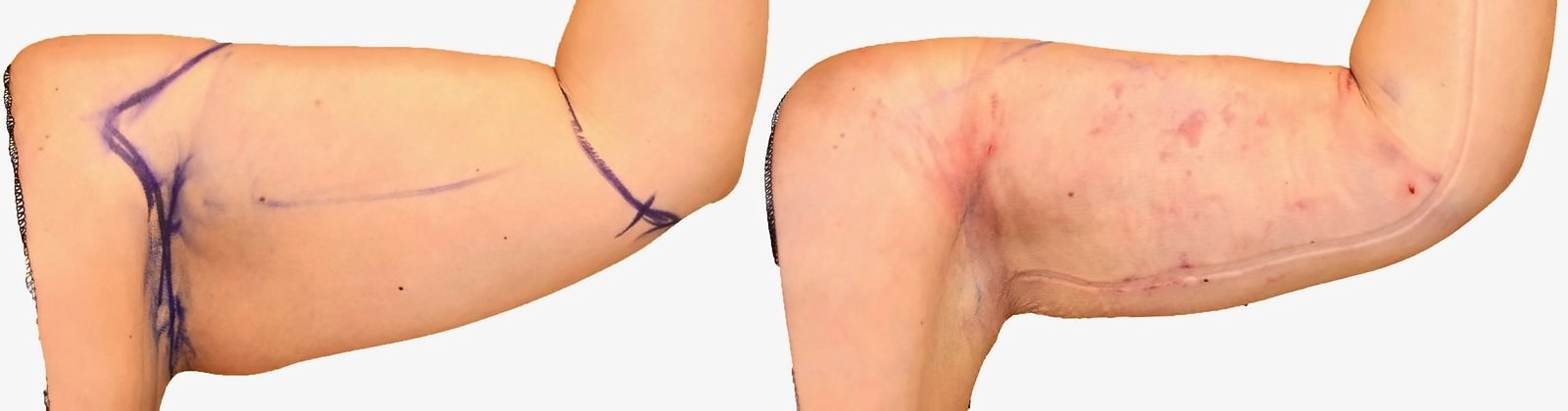 Before/After Arm liposuction before and after, actual patient of Dr. Long