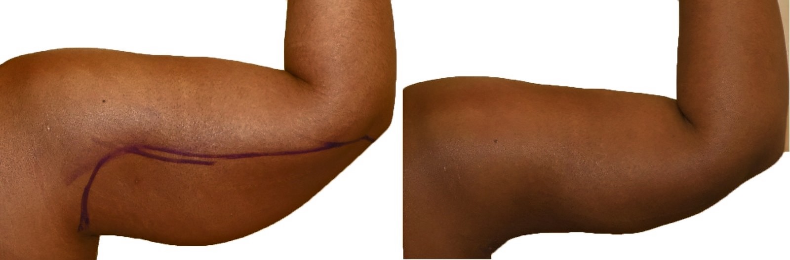 Before/After Arm liposuction before and after, actual patient of Dr. Long