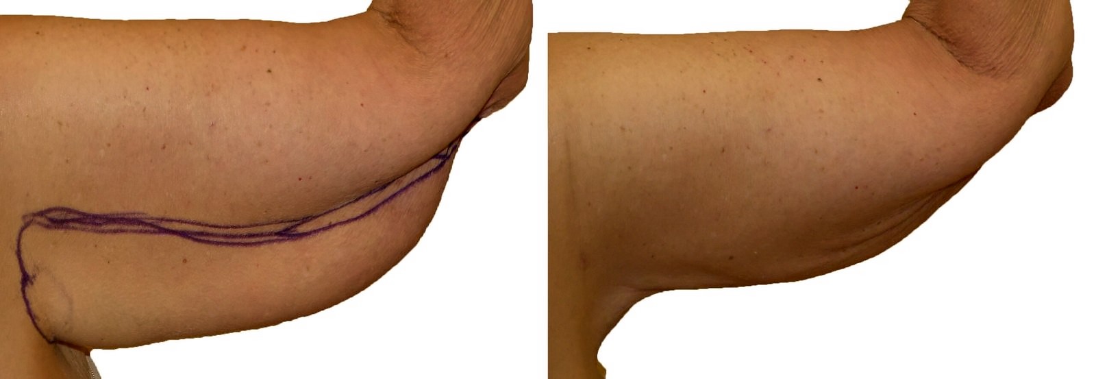 Before/After Arm liposuction before and after, actual patient of Dr. Long