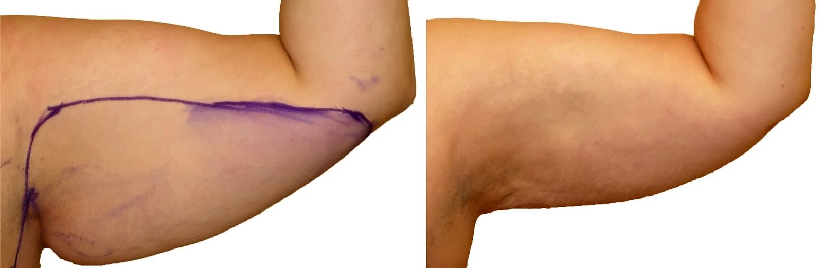 Before/After Arm liposuction before and after, actual patient of Dr. Long