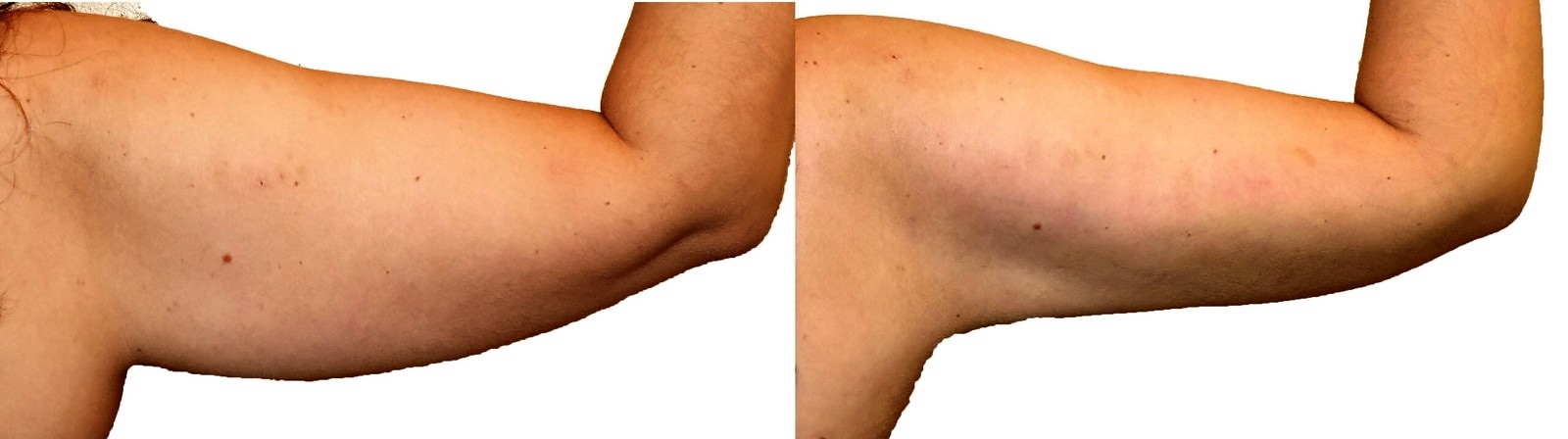 Before/After Arm liposuction before and after, actual patient of Dr. Long