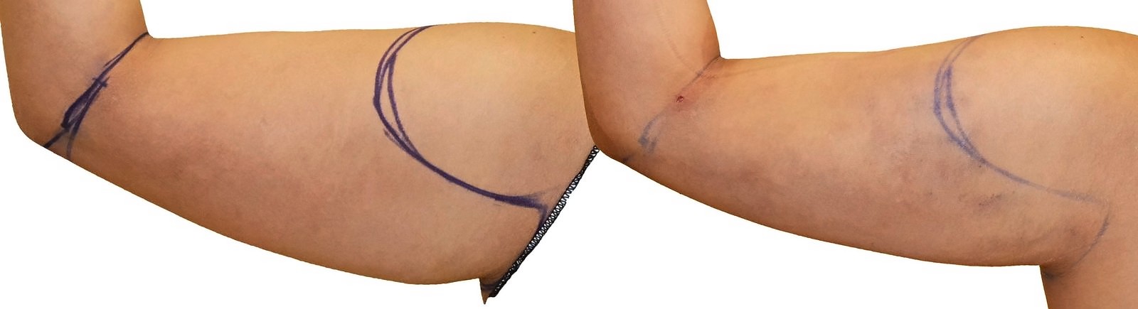 Before/After Arm liposuction before and after, actual patient of Dr. Long