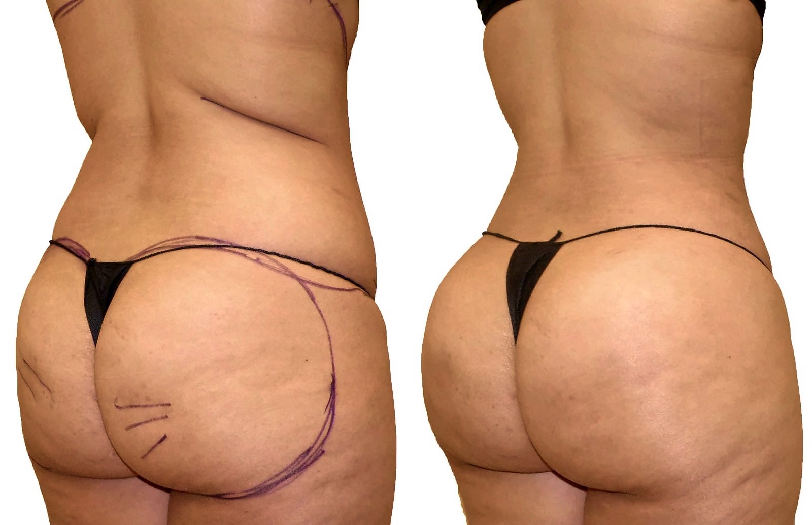 Before/After Fat Transfer, BBL before and after, actual patient of Dr. Long