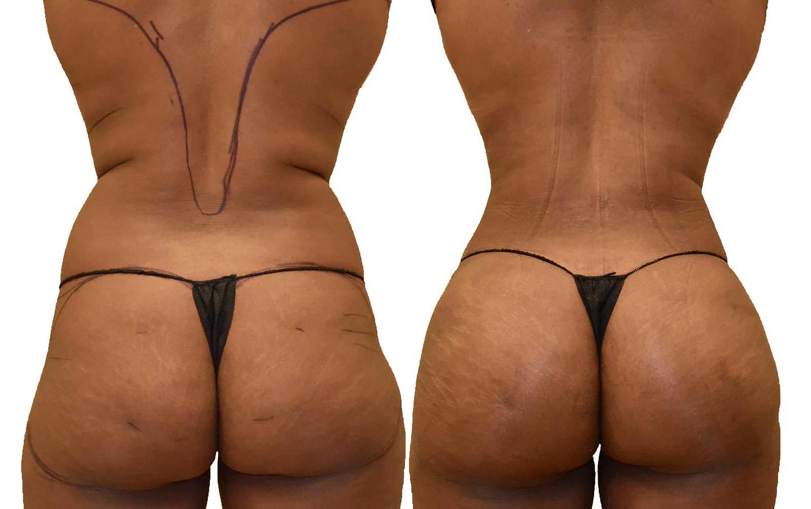 Before/After Fat Transfer, BBL before and after, actual patient of Dr. Long