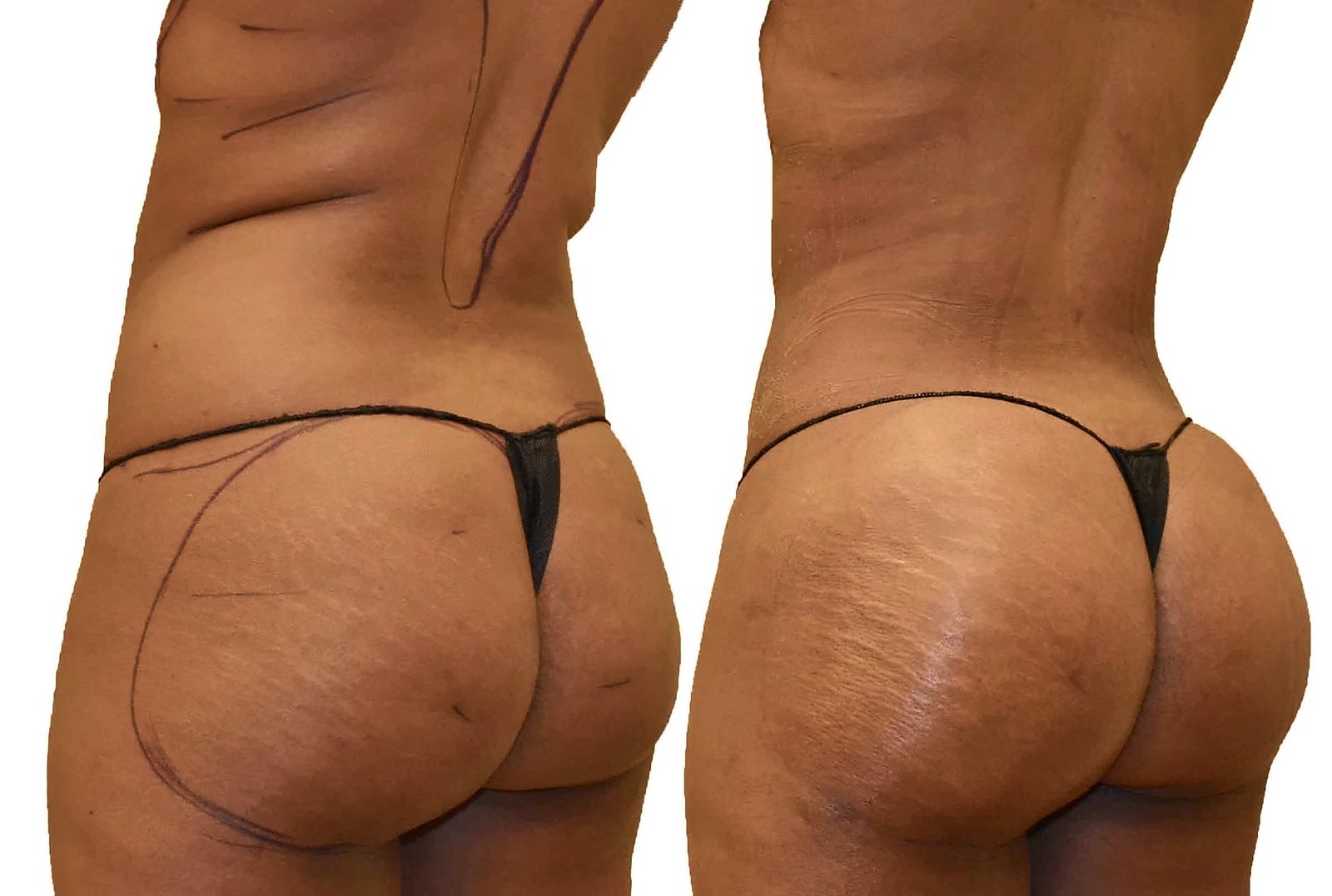Before/After Fat Transfer, BBL before and after, actual patient of Dr. Long