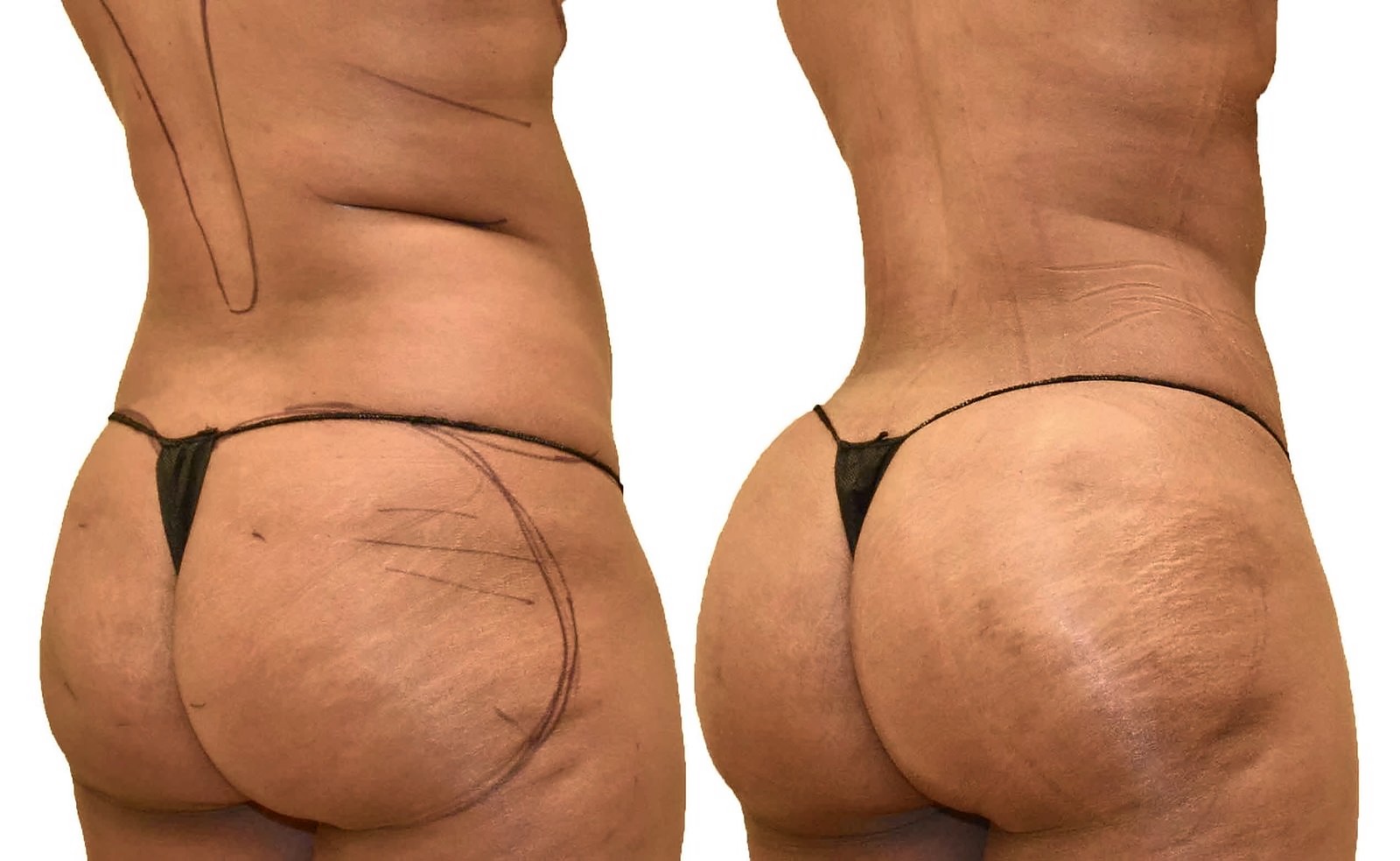 Before/After Fat Transfer, BBL before and after, actual patient of Dr. Long