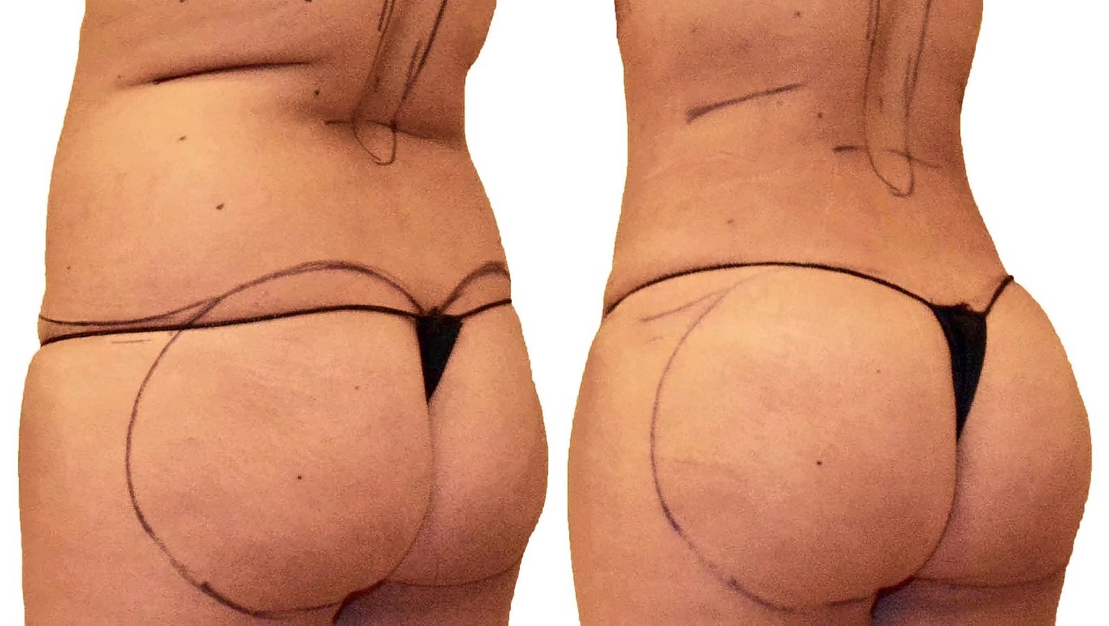 Before/After Fat Transfer, BBL before and after, actual patient of Dr. Long
