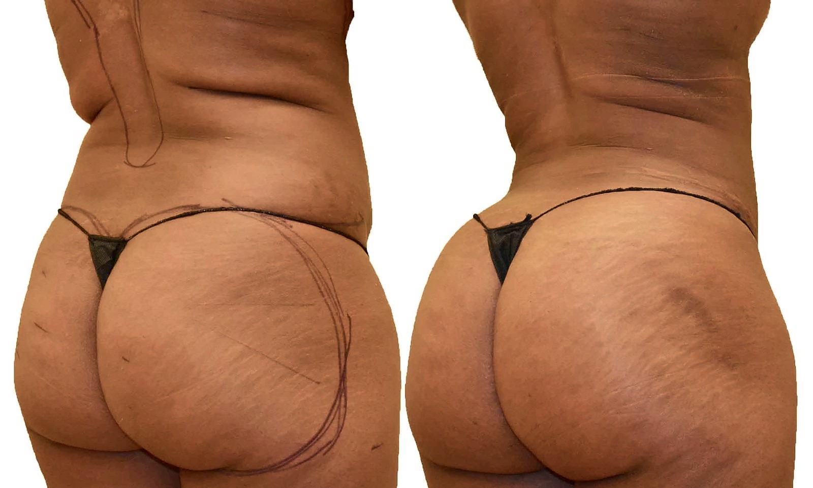 Before/After Fat Transfer, BBL before and after, actual patient of Dr. Long