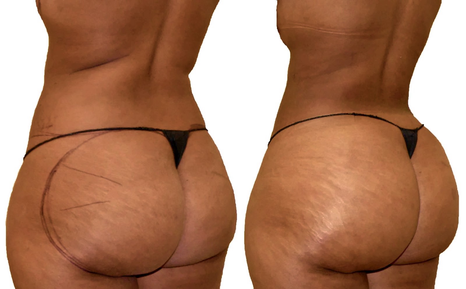 Before/After Fat Transfer, BBL before and after, actual patient of Dr. Long