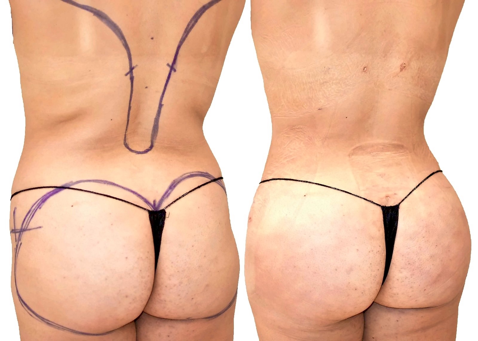 Before/After Fat Transfer, BBL before and after, actual patient of Dr. Long