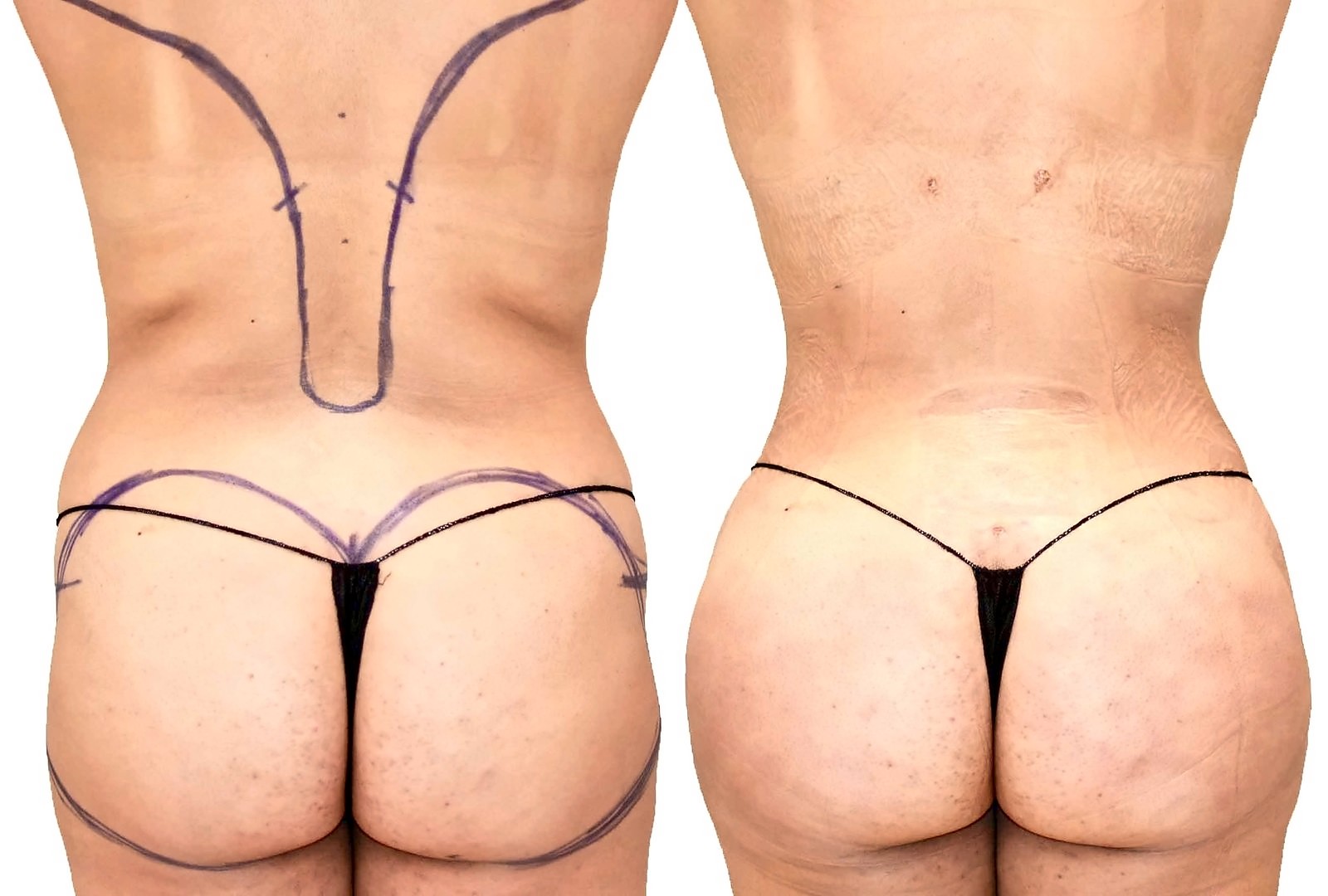 Before/After Fat Transfer, BBL before and after, actual patient of Dr. Long