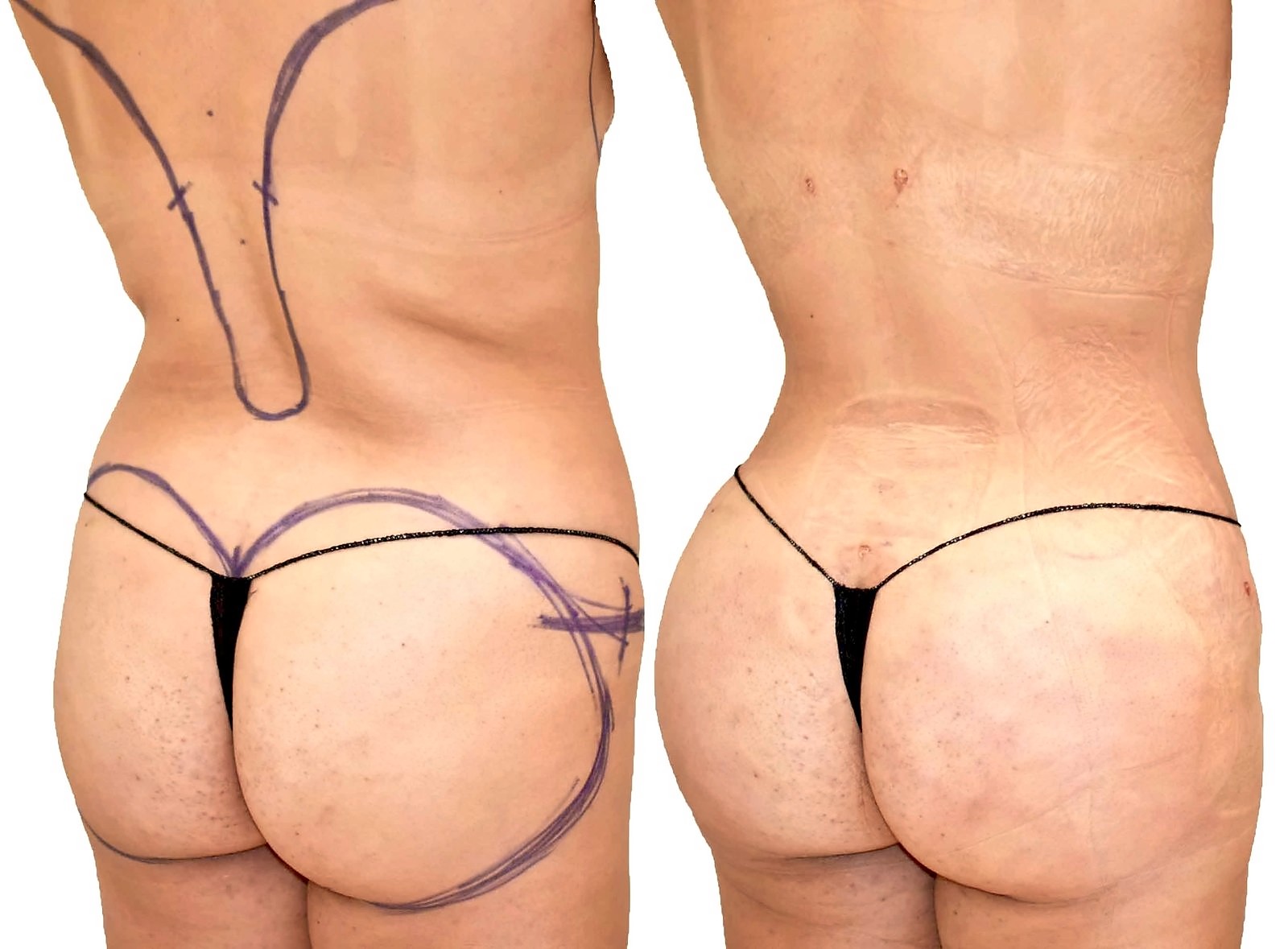Before/After Fat Transfer, BBL before and after, actual patient of Dr. Long
