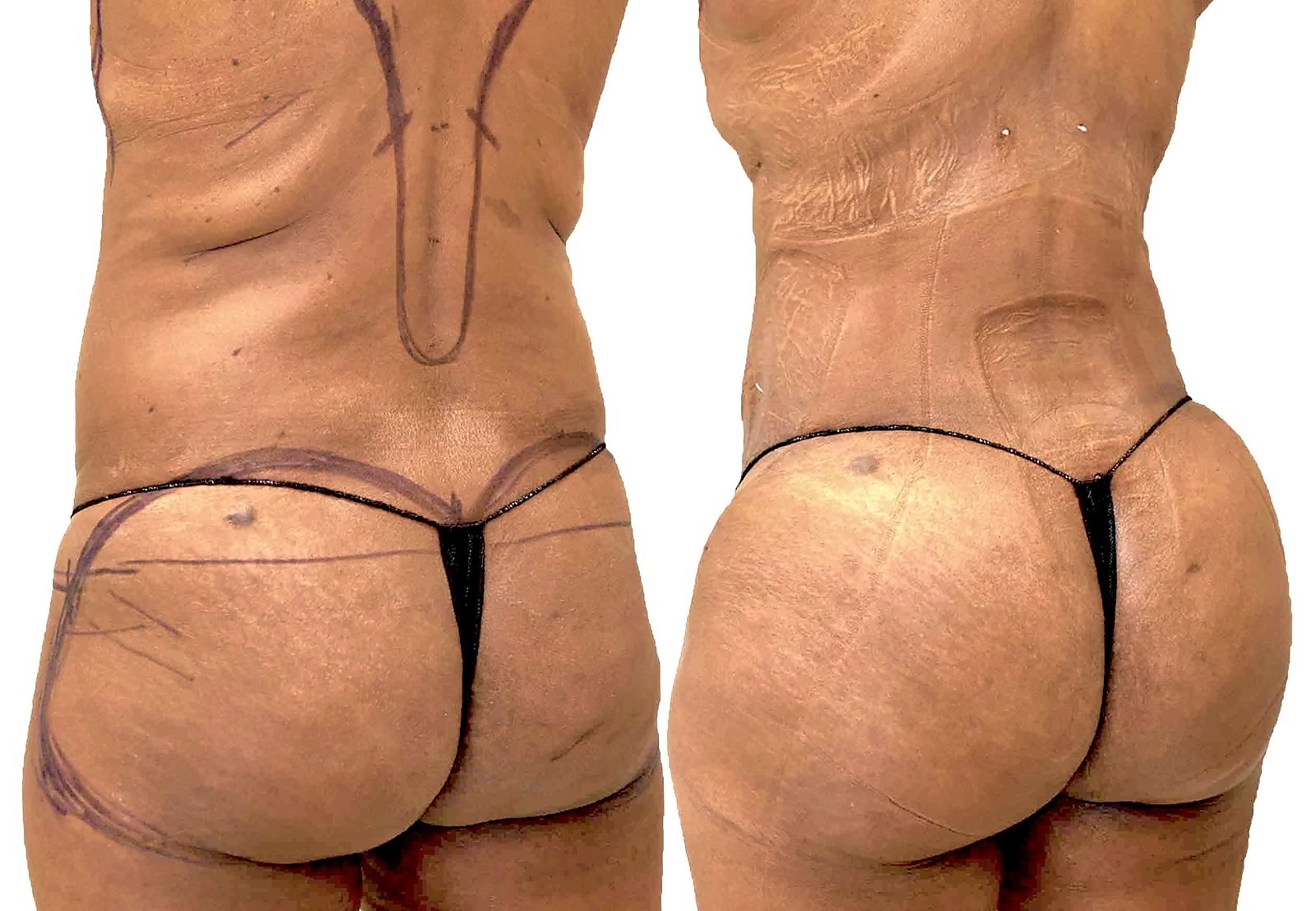 Before/After Fat Transfer, BBL before and after, actual patient of Dr. Long