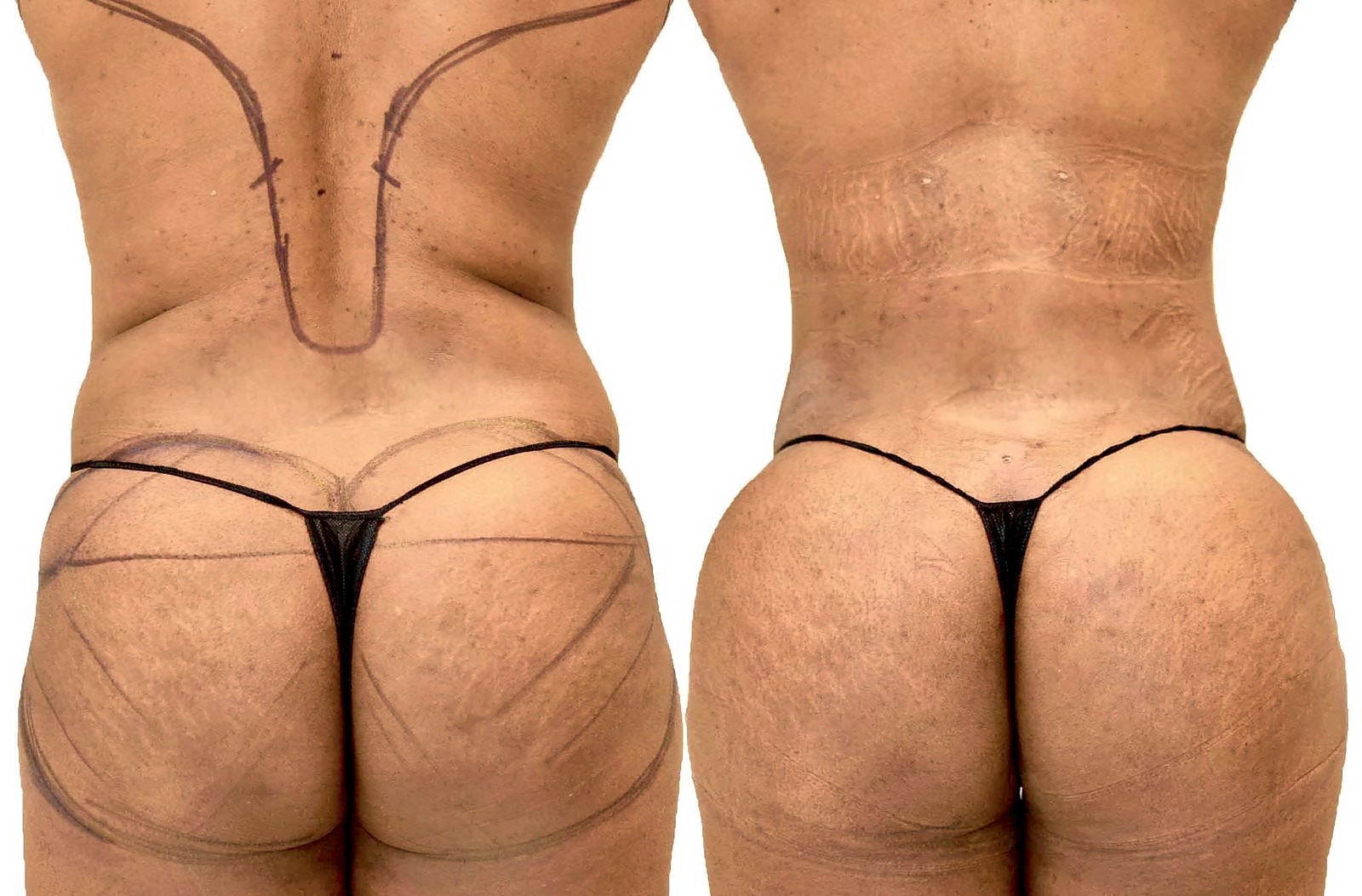 Before/After Fat Transfer, BBL before and after, actual patient of Dr. Long