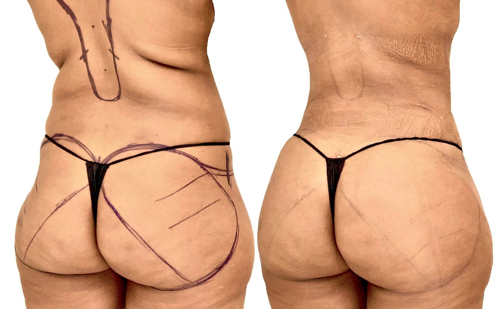 Before/After Fat Transfer, BBL before and after, actual patient of Dr. Long