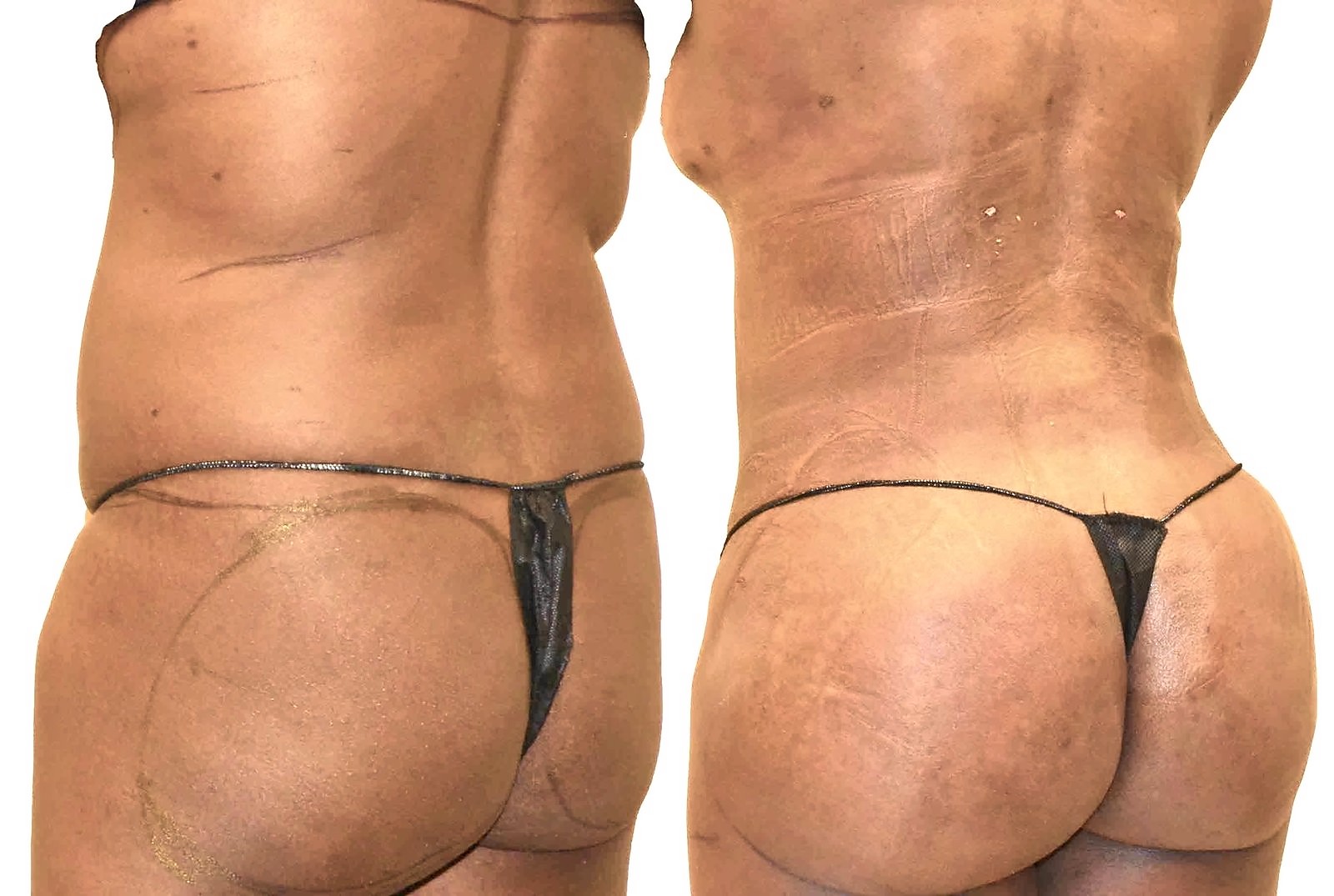 Before/After Fat Transfer, BBL before and after, actual patient of Dr. Long