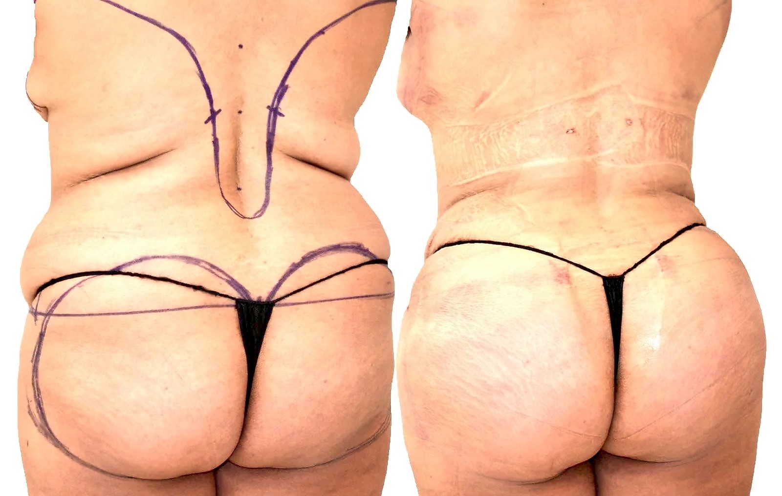 Before/After Fat Transfer, BBL before and after, actual patient of Dr. Long