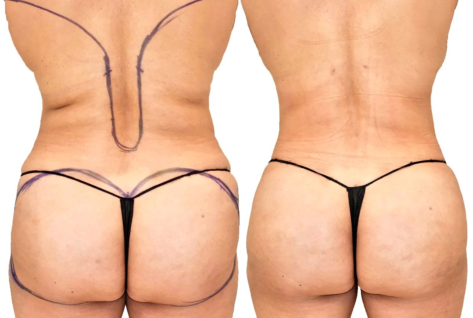 Before/After Fat Transfer, BBL before and after, actual patient of Dr. Long