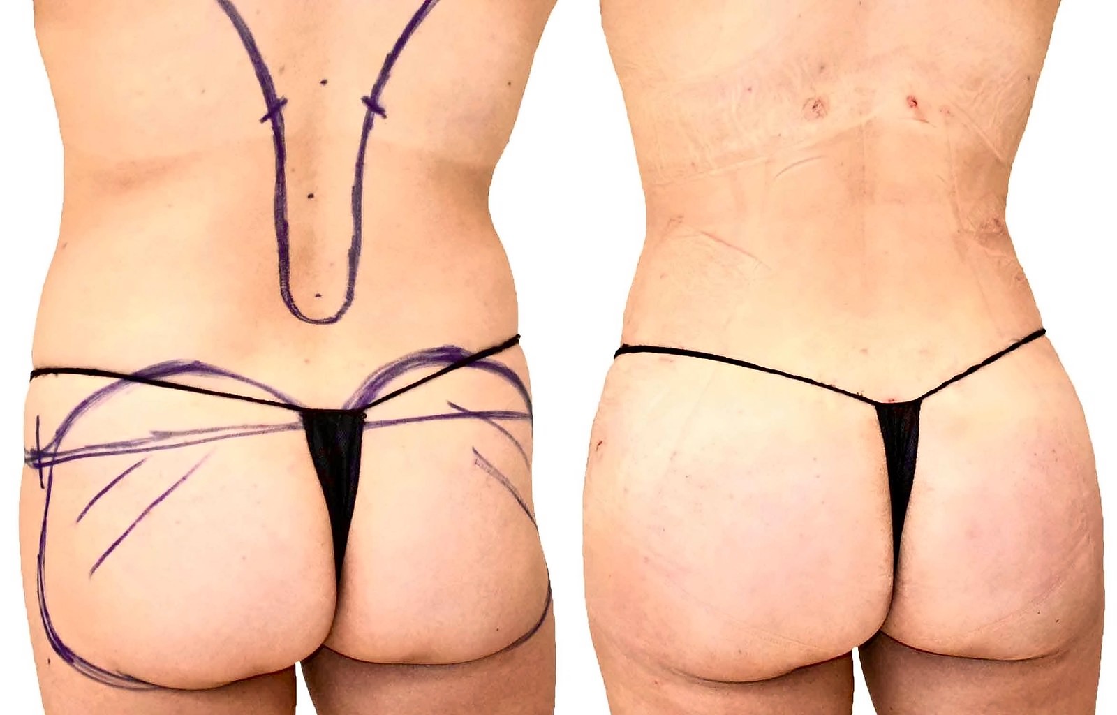 Before/After Fat Transfer, BBL before and after, actual patient of Dr. Long